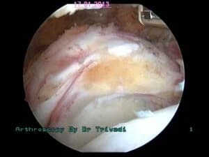 supraspinatus tear very retracted