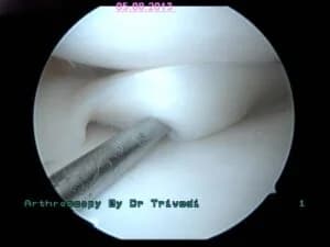 ACL Reconstruction Using Biodegradable Screws